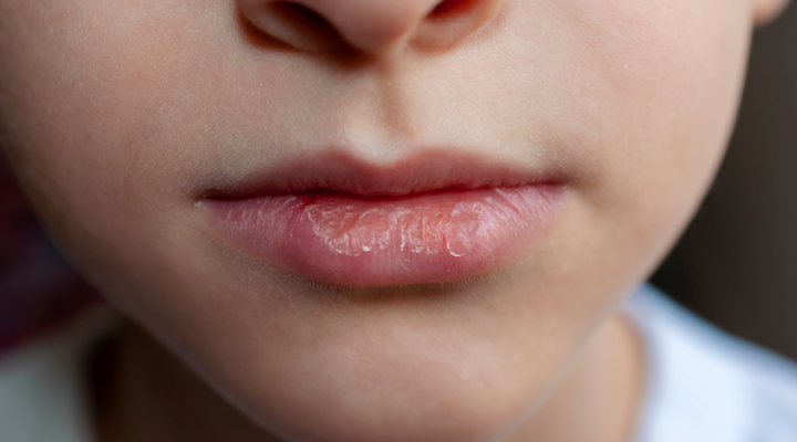 Say Goodbye to Chapped Lips: Unveiling Causes and Effective Treatments